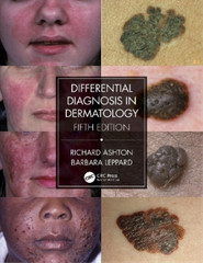 Barbara Leppard Richard Ashton Differential Diagnosis in Dermatology (Paperback)