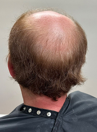 Back of a balding person’s head with thinning brown hair, seated in a chair with a dark collar.