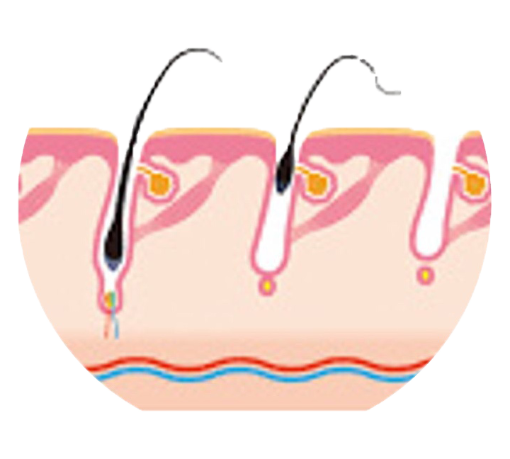 Hair growth cycle diagram showing hair follicles in skin, with one growing hair and two shedding hairs.