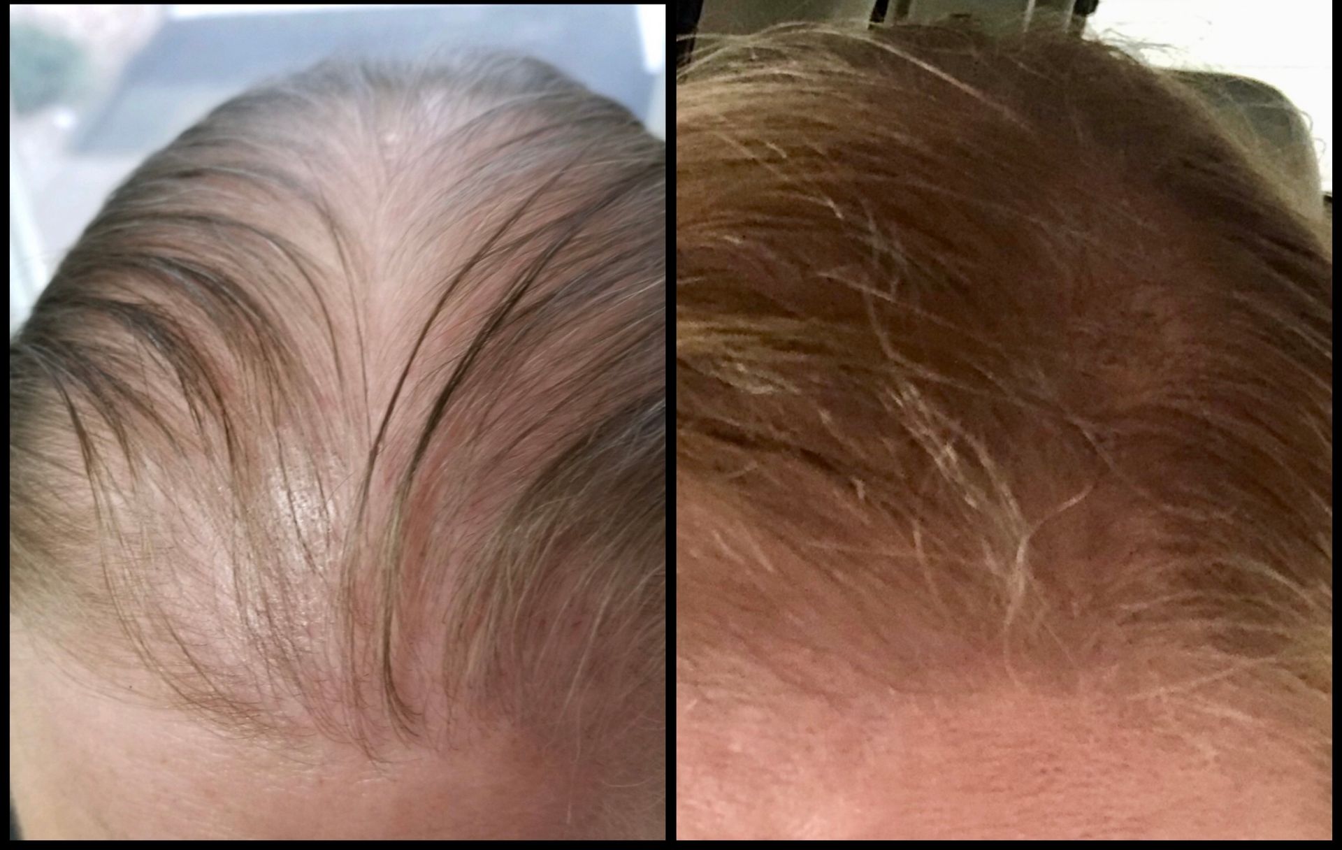 Side-by-side close-up of a scalp with thinning hair, showing before-and-after hair growth.